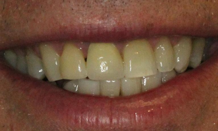 new custom crown to match surrounding teeth