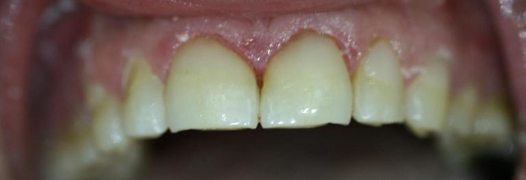 fillings used to fix coffee staining on teeth