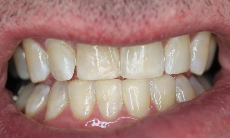 smooth front teeth after bonding