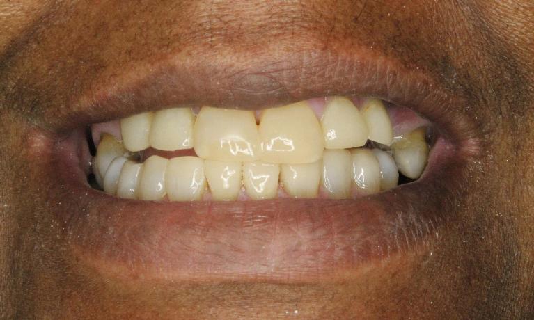 composite bonding used to fix this patient's worn teeth