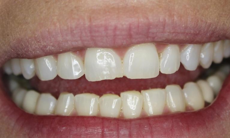Chipped front tooth before restoration