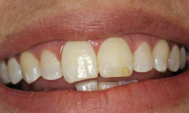 Old bonding on tooth before reshaping