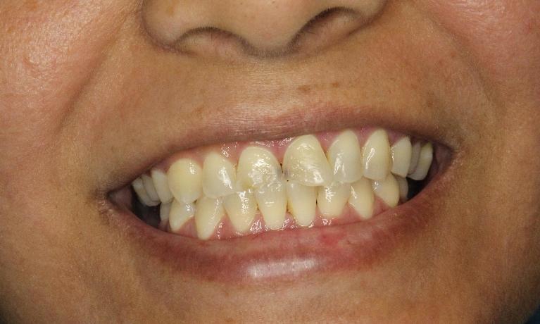 worn and eroded front teeth before crowns