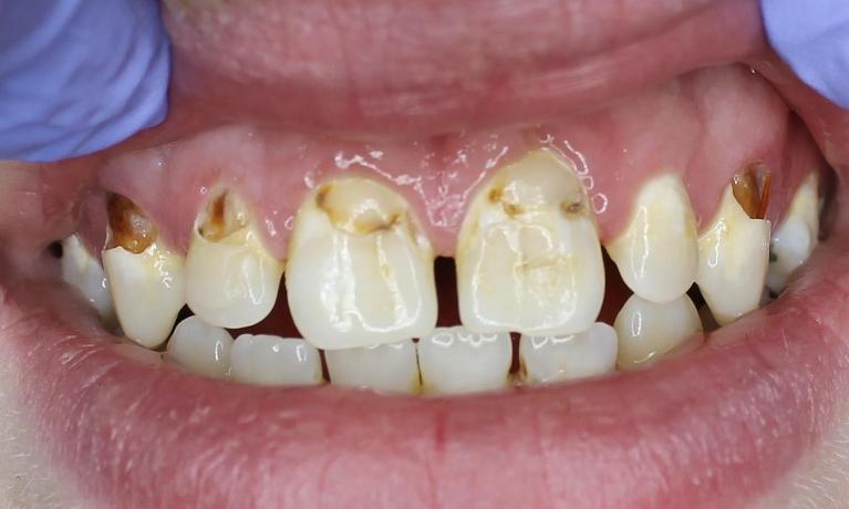 decayed front teeth before dental fillings