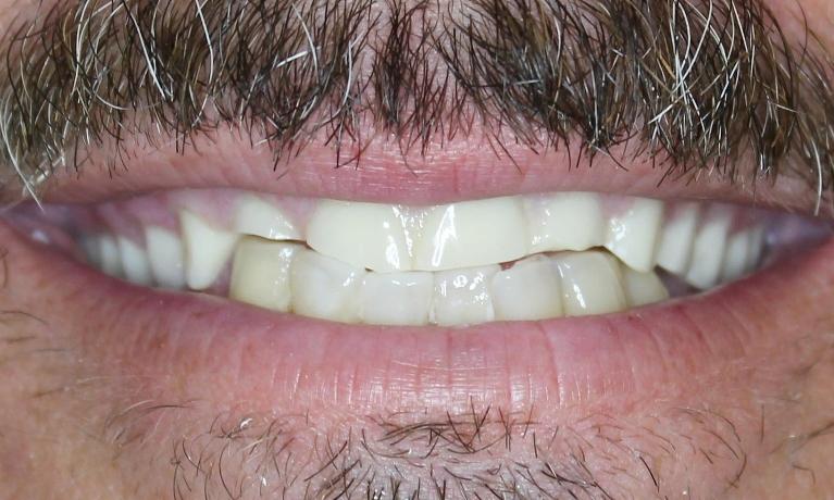 New-Denture-and-Partial-Before-Image