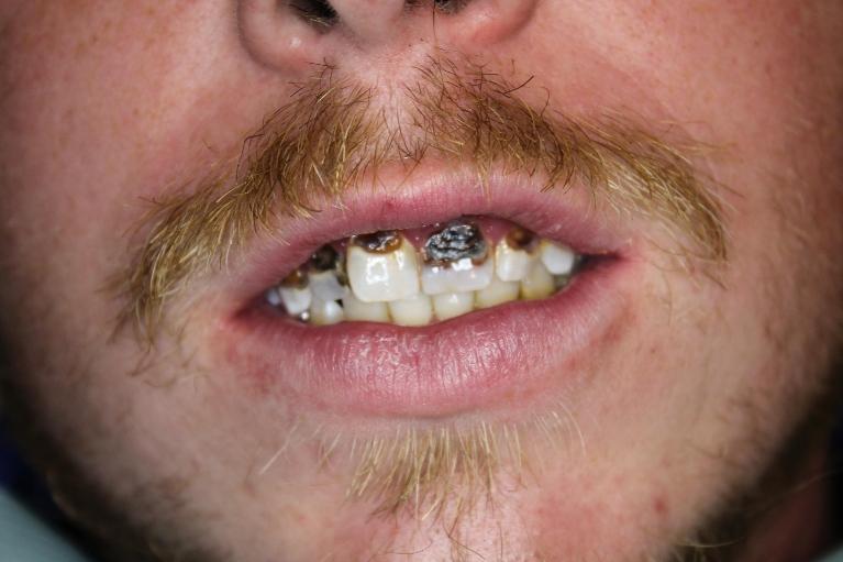 decayed front teeth