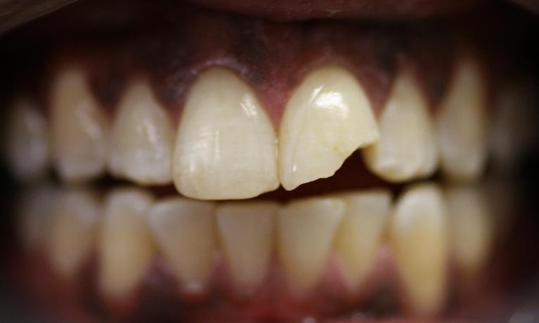 front tooth broken from sports injury