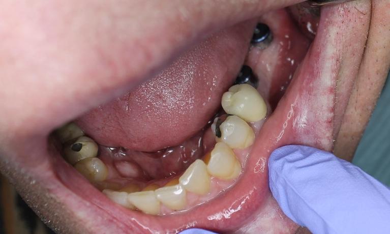 back dental implants without crowns