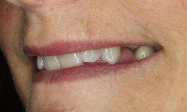 Implant-Placement-and-Crown-Before-Image