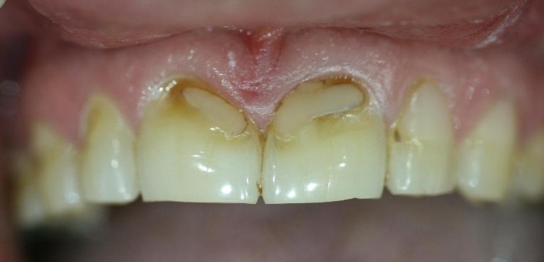 staining from coffee on front tooth