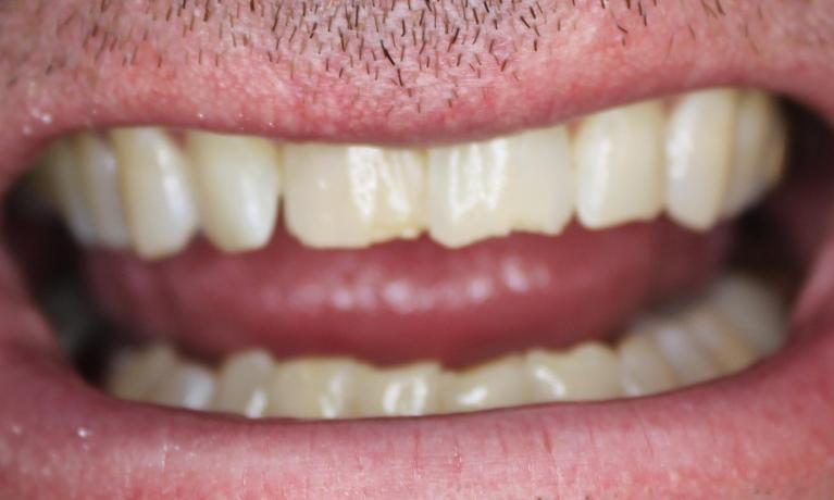 worn front teeth before bonding