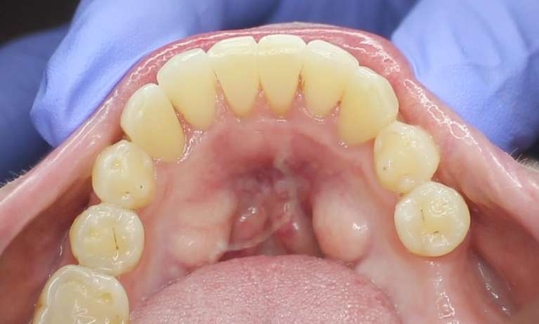 straight teeth in lower jaw after aligner teeth straightening