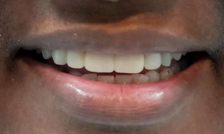 Bridge After