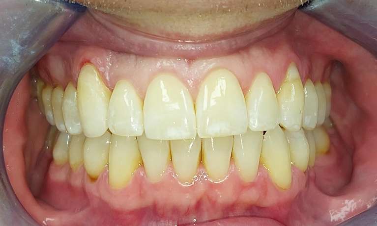 patient's smile after clear aligners