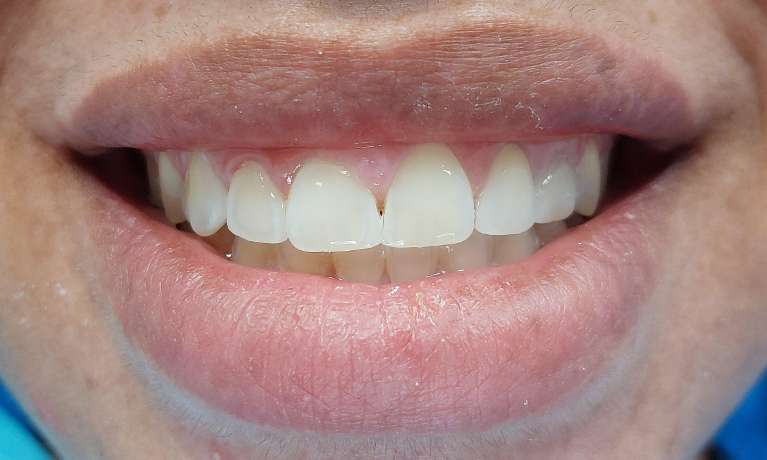 dental bonding used to close gap between top front teeth