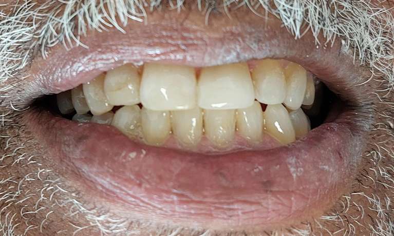 patient's repaired front tooth