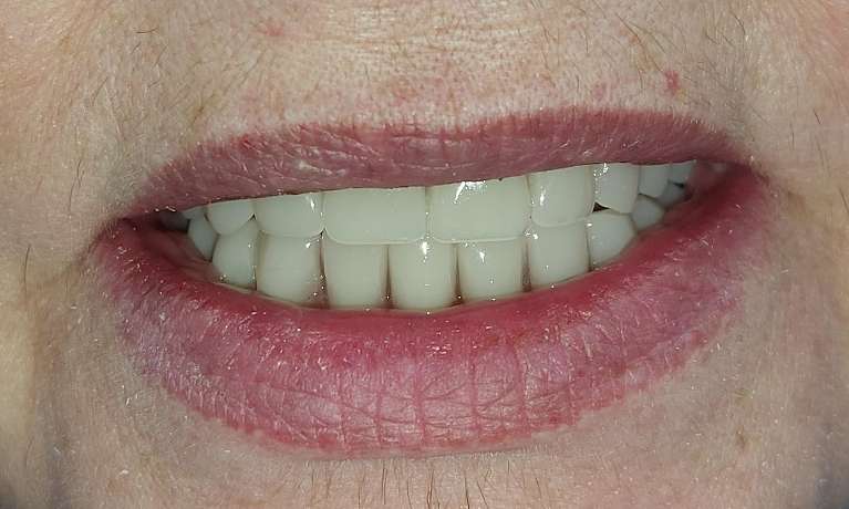 Total-Teeth-Replacement-and-Locator-Overdenture-After-Image