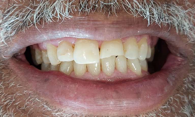 chipped front tooth