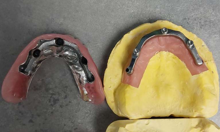 Snap on Dentures before