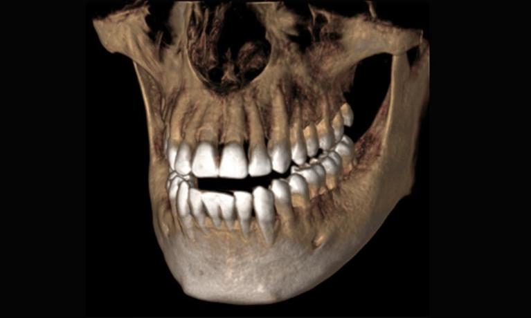 CBCT 3D Radiographs
