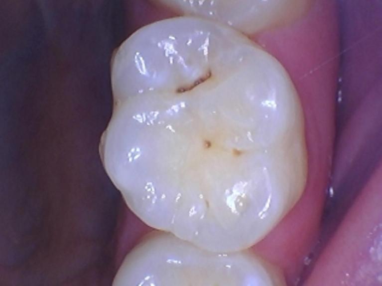 Intraoral Camera at Hopewell Family Dentistry