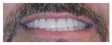 Hopewell Family Dentistry After Smile
